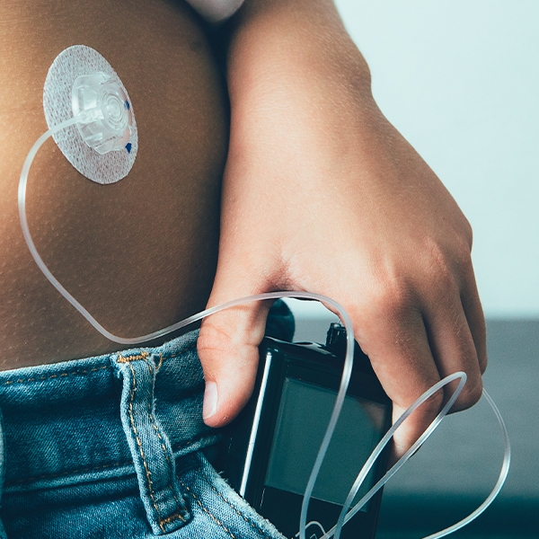 Diabetes tipo 1 patologia